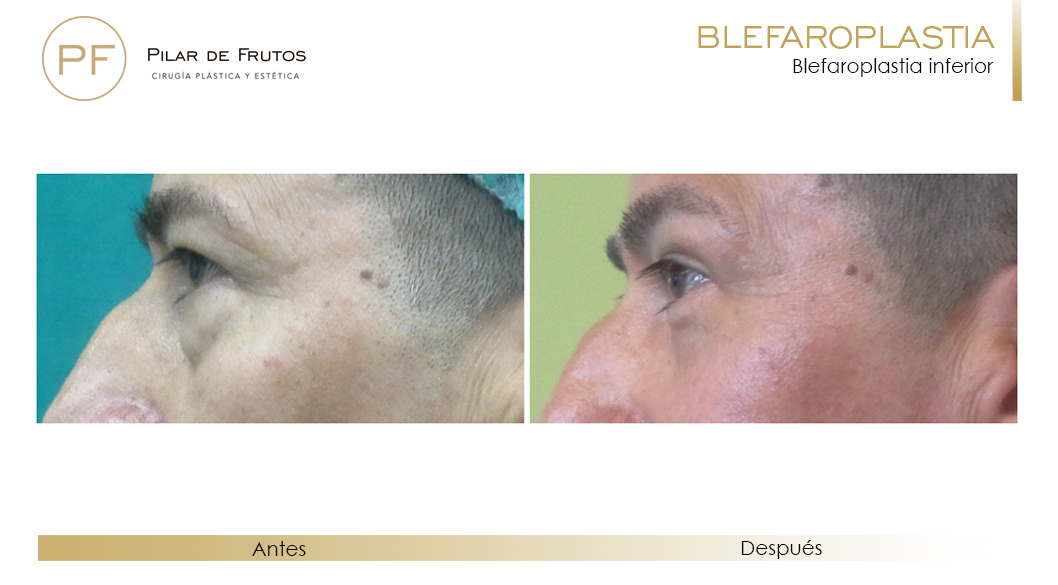 Fotos de Blefaroplastia antes y después Fotos de Blefaroplastia antes y después