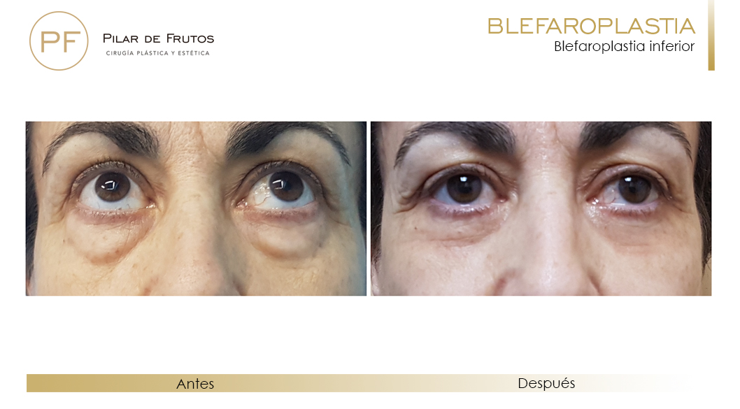 Fotos de Blefaroplastia antes y después Fotos de Blefaroplastia antes y después