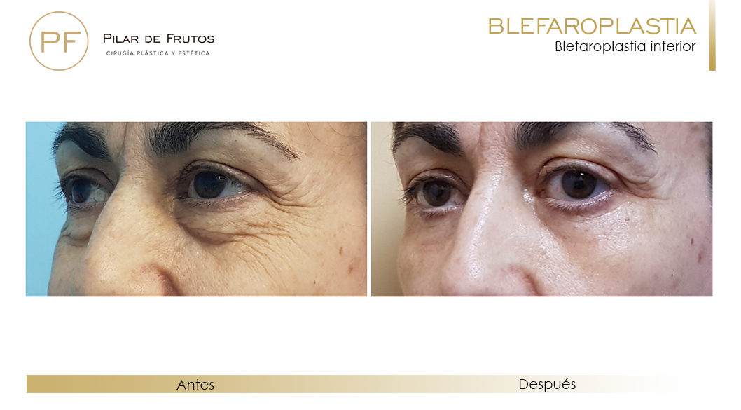 Fotos de Blefaroplastia antes y después Fotos de Blefaroplastia antes y después