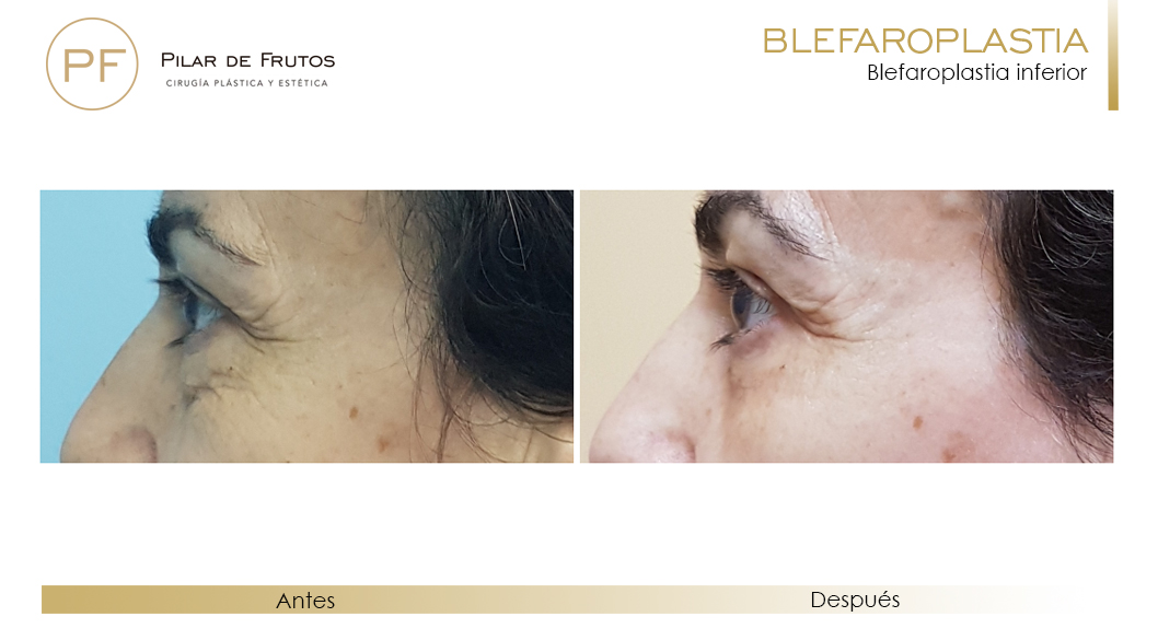Fotos de Blefaroplastia antes y después Fotos de Blefaroplastia antes y después