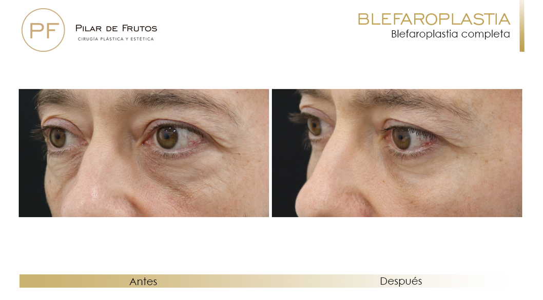 Fotos de Blefaroplastia antes y después Fotos de Blefaroplastia antes y después
