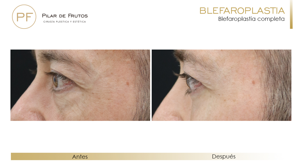Fotos de Blefaroplastia antes y después Fotos de Blefaroplastia antes y después