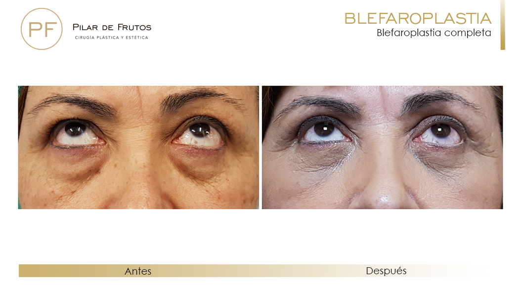 Fotos de Blefaroplastia antes y después Fotos de Blefaroplastia antes y después