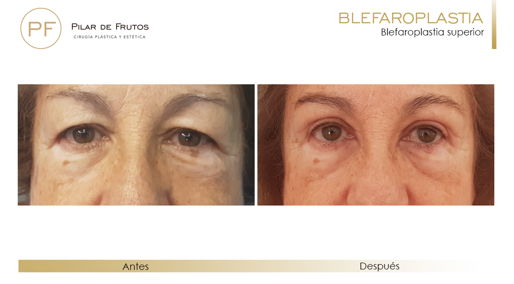 Fotos de Blefaroplastia antes y después Fotos de Blefaroplastia antes y después