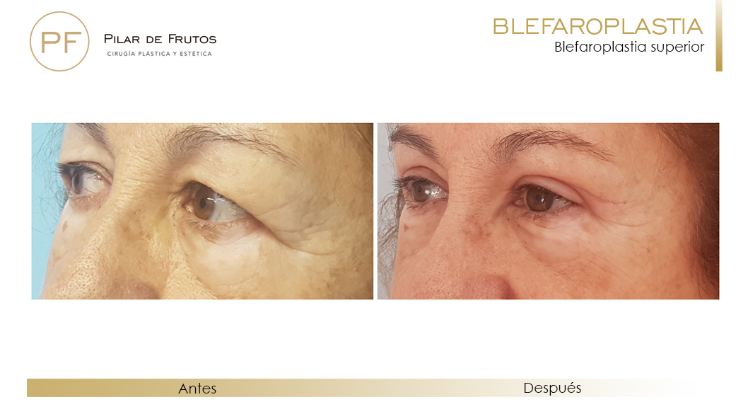 Fotos de Blefaroplastia antes y después Fotos de Blefaroplastia antes y después