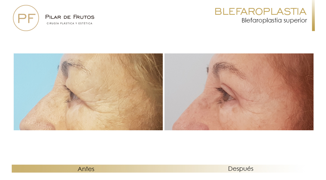 Fotos de Blefaroplastia antes y después Fotos de Blefaroplastia antes y después