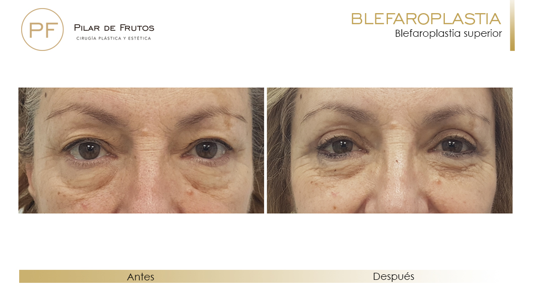 Fotos de Blefaroplastia antes y después Fotos de Blefaroplastia antes y después