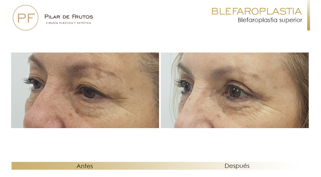 Fotos de Blefaroplastia antes y después Fotos de Blefaroplastia antes y después