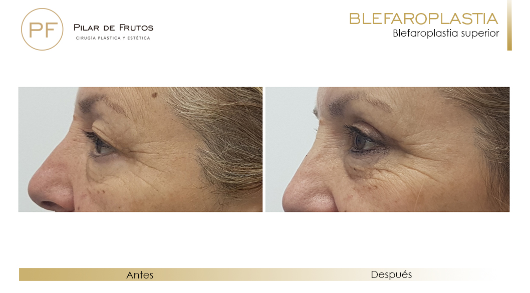 Fotos de Blefaroplastia antes y después Fotos de Blefaroplastia antes y después