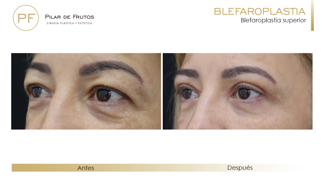 Fotos de Blefaroplastia antes y después Fotos de Blefaroplastia antes y después