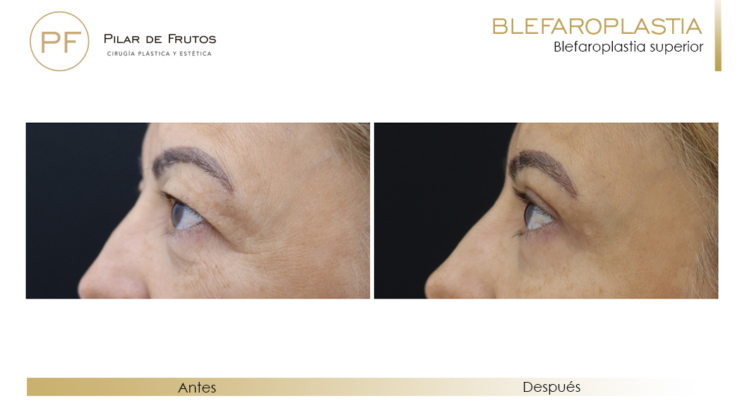Fotos de Blefaroplastia antes y después Fotos de Blefaroplastia antes y después