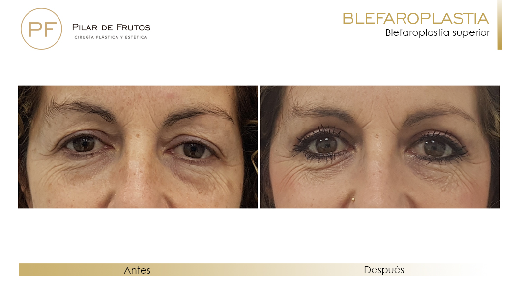 Fotos de Blefaroplastia antes y después Fotos de Blefaroplastia antes y después