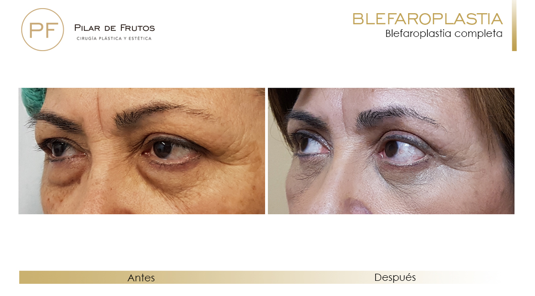 Fotos de Blefaroplastia antes y después Fotos de Blefaroplastia antes y después
