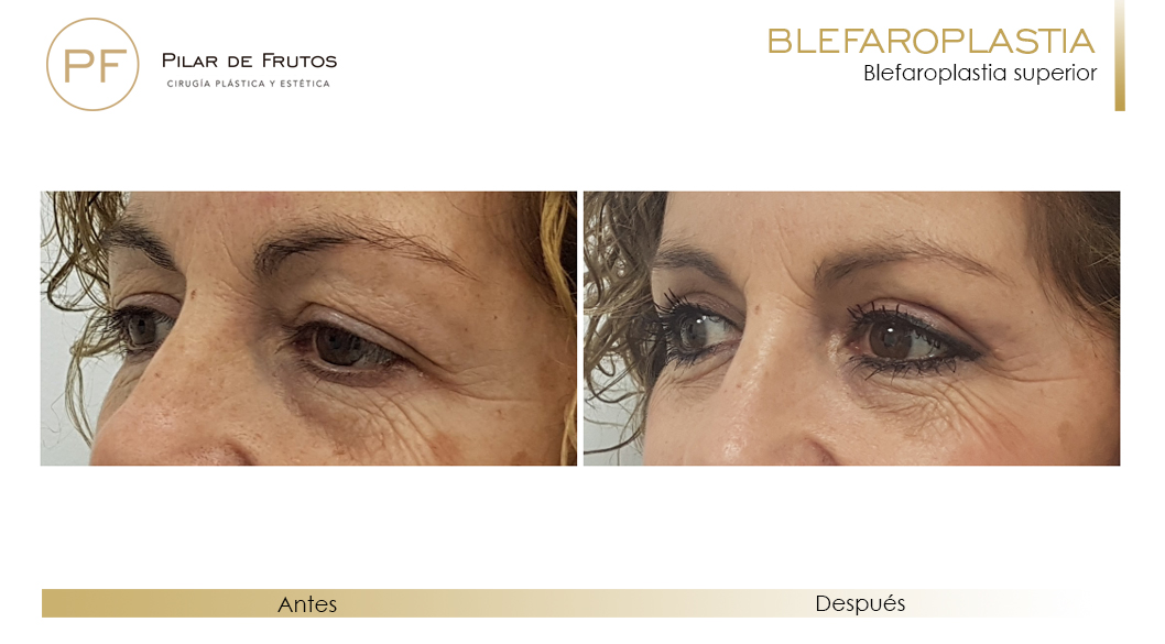 Fotos de Blefaroplastia antes y después Fotos de Blefaroplastia antes y después