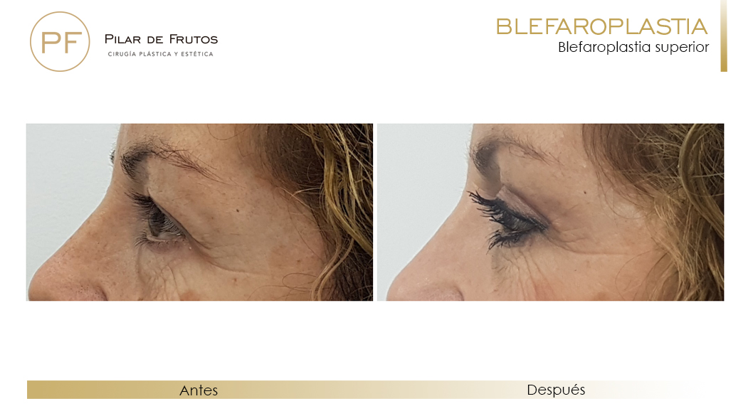 Fotos de Blefaroplastia antes y después Fotos de Blefaroplastia antes y después