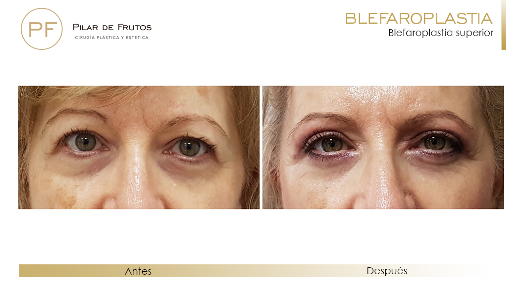 Fotos de Blefaroplastia antes y después Fotos de Blefaroplastia antes y después