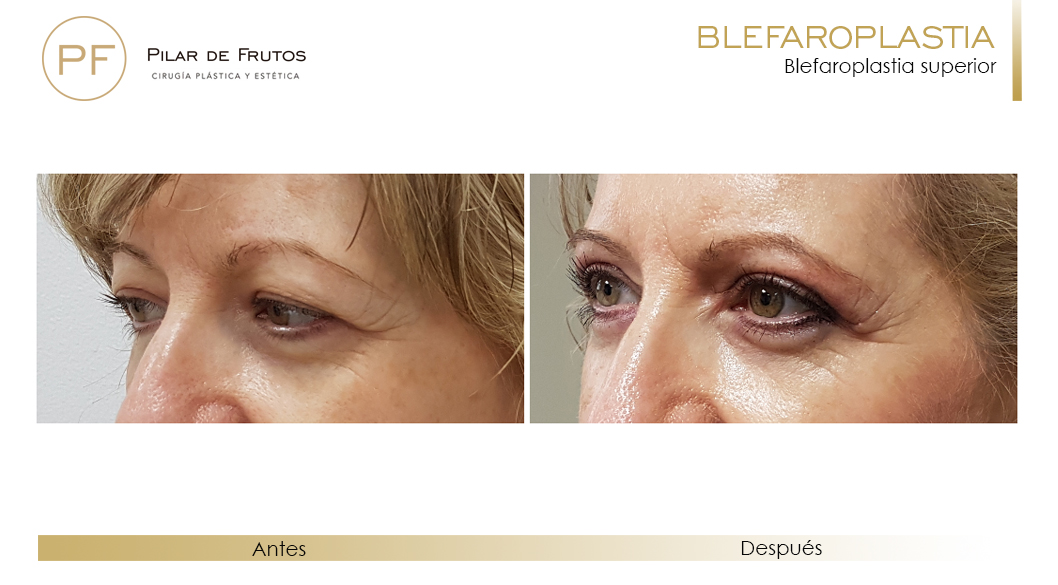 Fotos de Blefaroplastia antes y después Fotos de Blefaroplastia antes y después