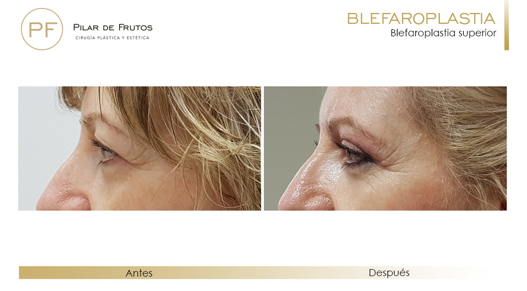 Fotos de Blefaroplastia antes y después Fotos de Blefaroplastia antes y después