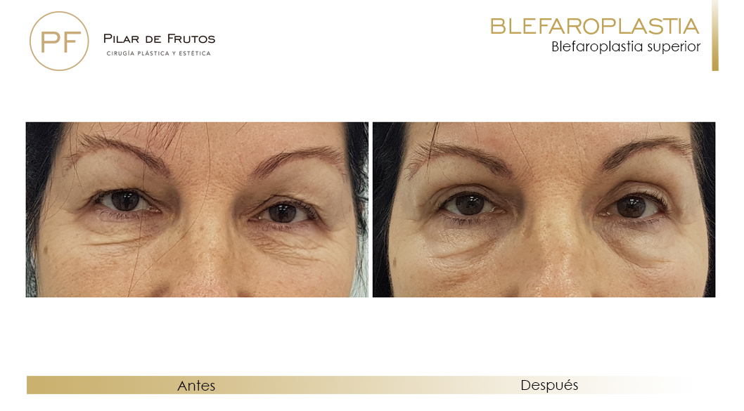 blefaroplastia_pilar_de_frutos_35 Fotos de Blefaroplastia antes y después