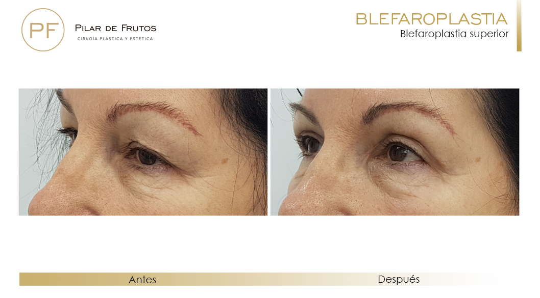 Fotos de Blefaroplastia antes y después Fotos de Blefaroplastia antes y después