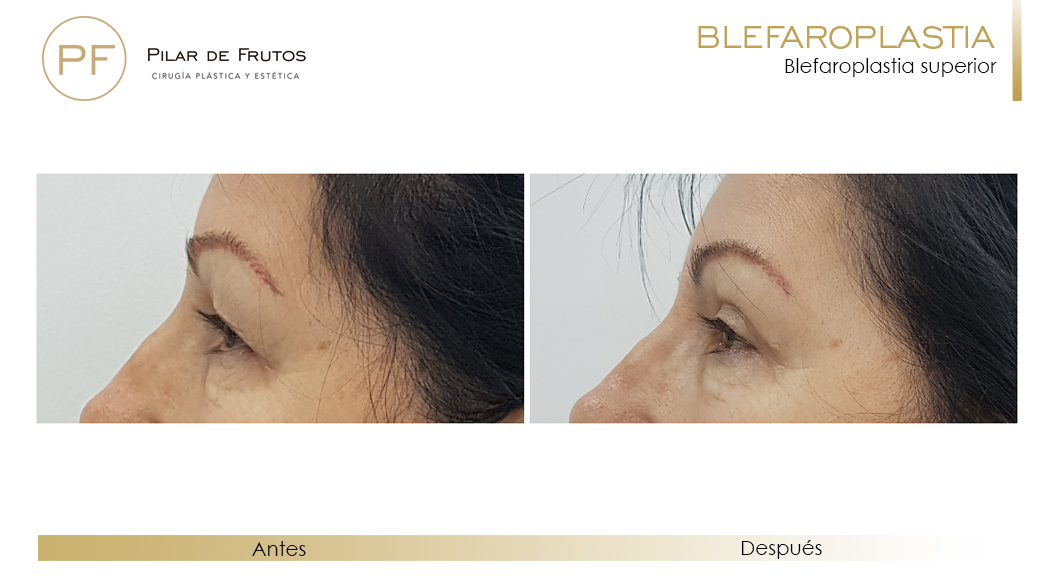 Fotos de Blefaroplastia antes y después Fotos de Blefaroplastia antes y después