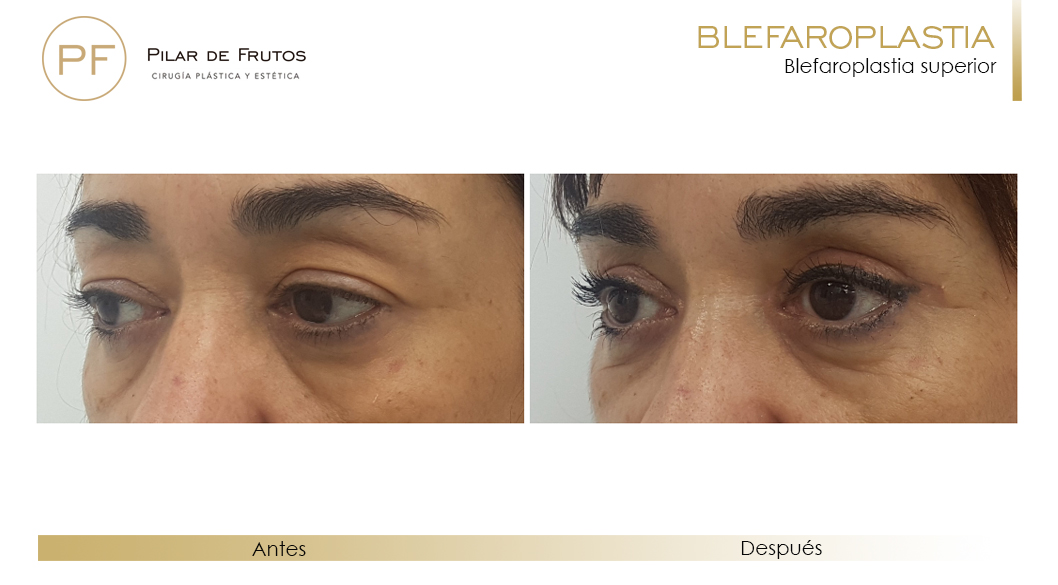Fotos de Blefaroplastia antes y después Fotos de Blefaroplastia antes y después