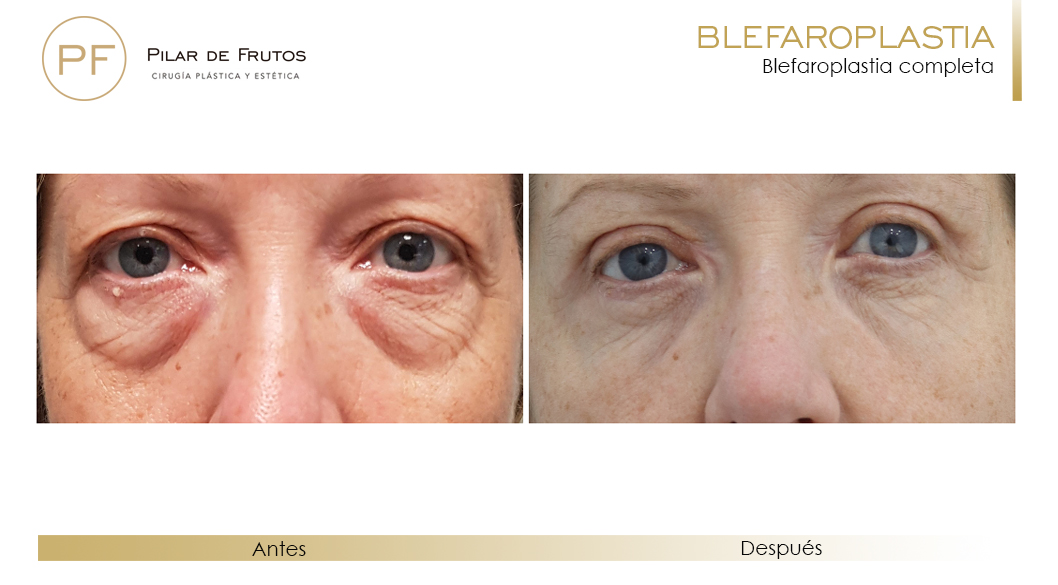 Fotos de Blefaroplastia antes y después Fotos de Blefaroplastia antes y después
