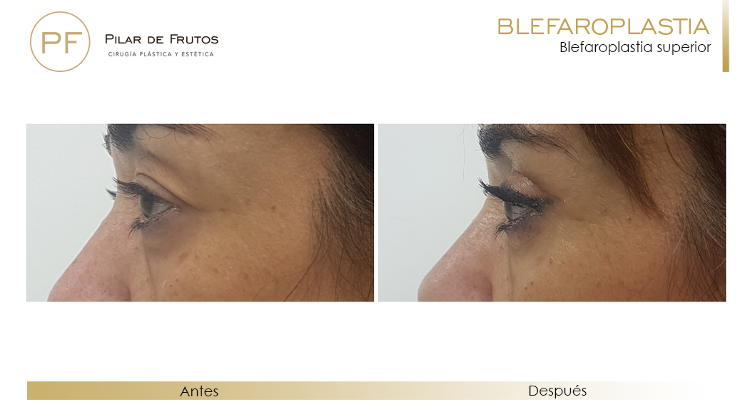 Fotos de Blefaroplastia antes y después Fotos de Blefaroplastia antes y después