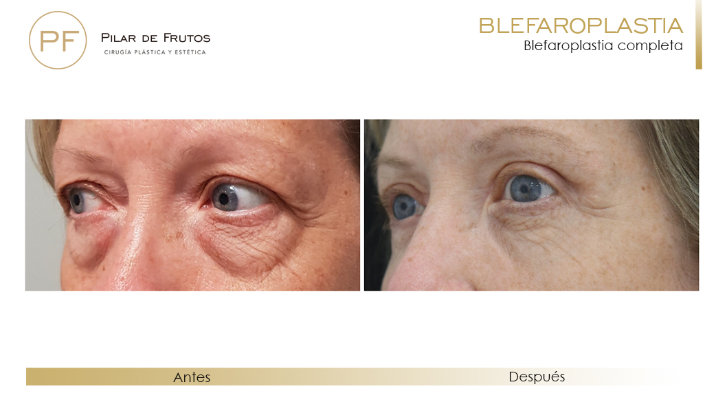 Fotos de Blefaroplastia antes y después Fotos de Blefaroplastia antes y después