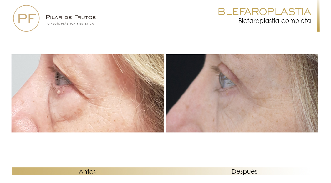 Fotos de Blefaroplastia antes y después Fotos de Blefaroplastia antes y después