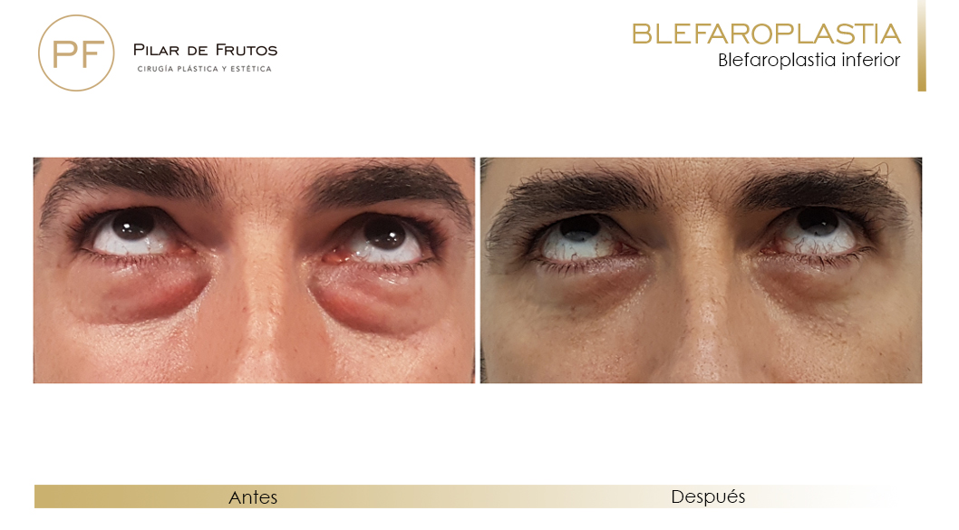 Fotos de Blefaroplastia antes y después Fotos de Blefaroplastia antes y después