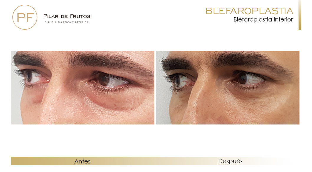 Fotos de Blefaroplastia antes y después Fotos de Blefaroplastia antes y después