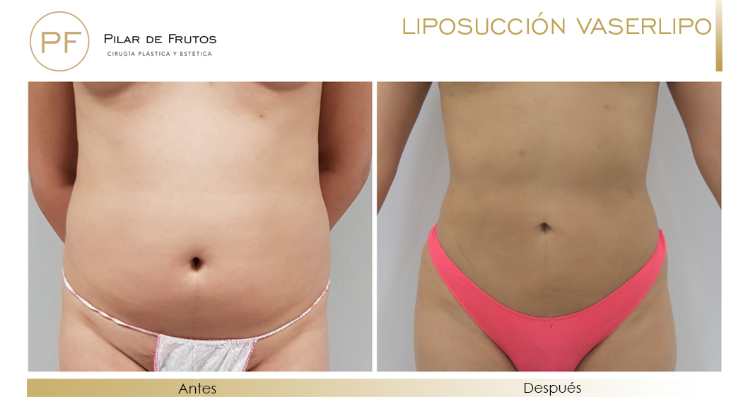 Vaser Lipo Liposucción Fotos antes y después
