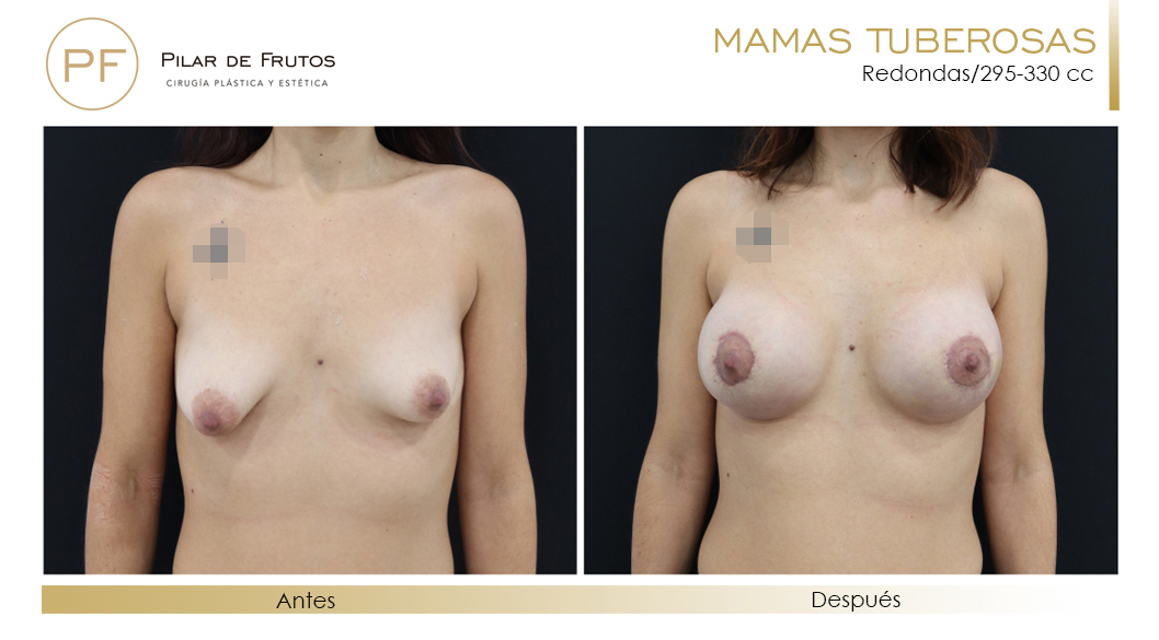 Mamas Tuberosas Antes y Después Mamas Tuberosas Antes y Después