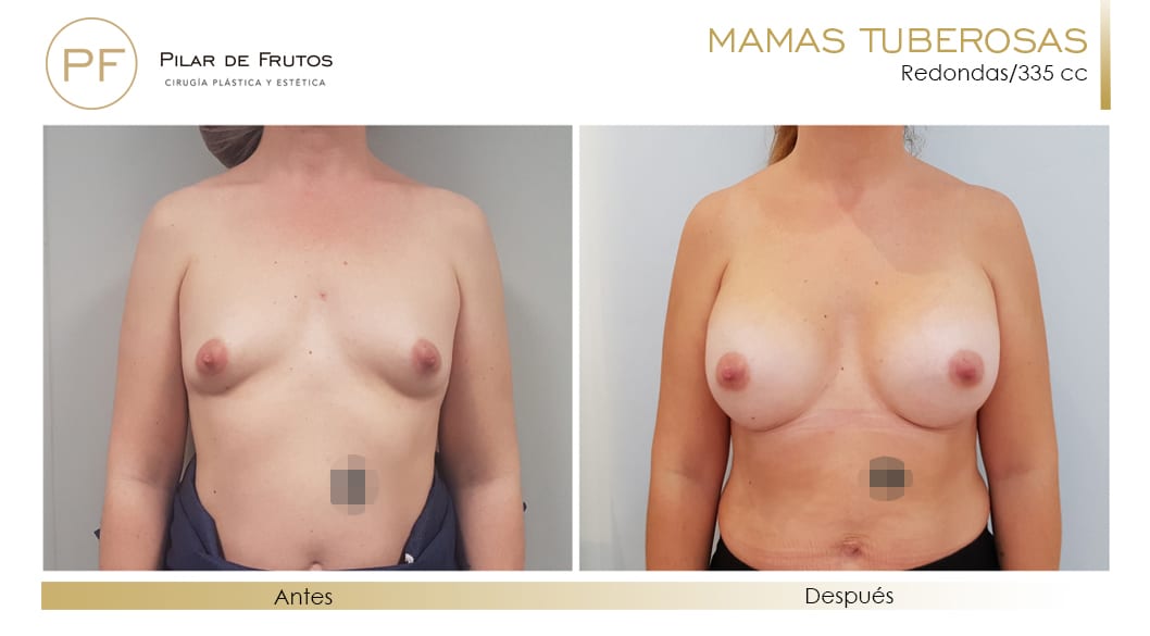 Mamas Tuberosas Antes y Después Mamas Tuberosas Antes y Después