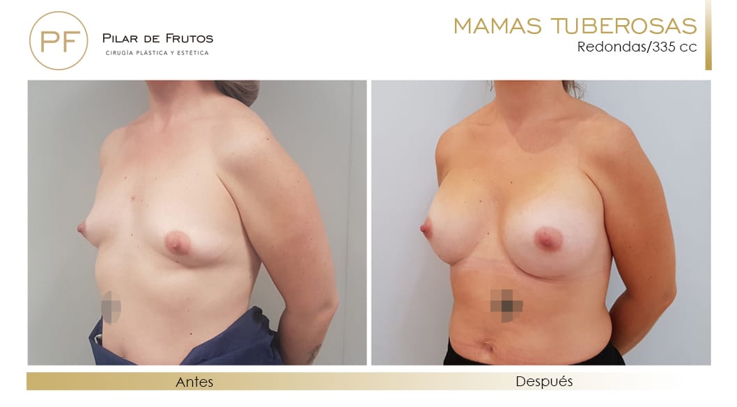 Mamas Tuberosas Antes y Después Mamas Tuberosas Antes y Después