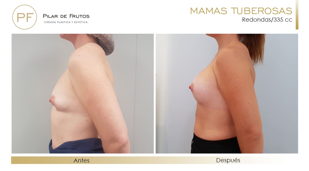 Mamas Tuberosas Antes y Después Mamas Tuberosas Antes y Después