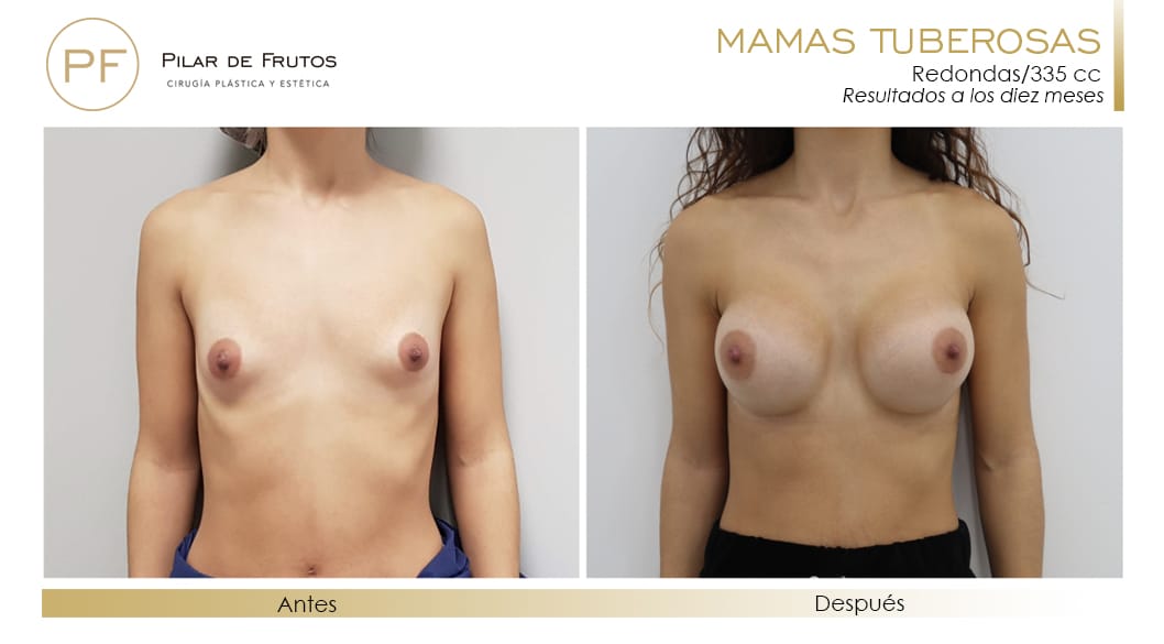Mamas Tuberosas Antes y Después Mamas Tuberosas Antes y Después