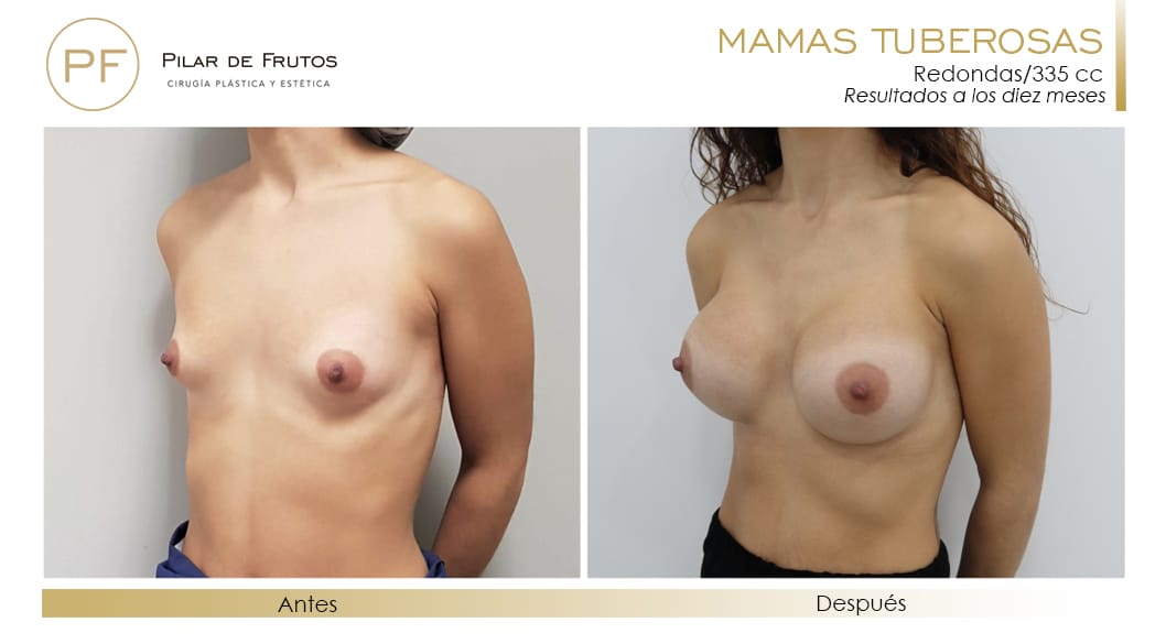 Mamas Tuberosas Antes y Después Mamas Tuberosas Antes y Después