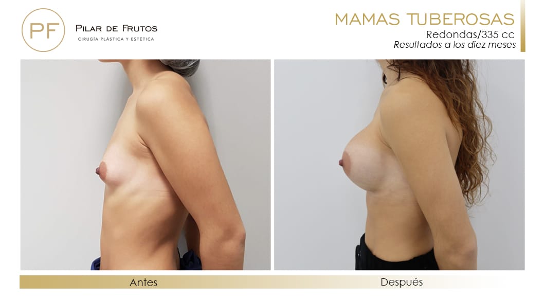 Mamas Tuberosas Antes y Después Mamas Tuberosas Antes y Después