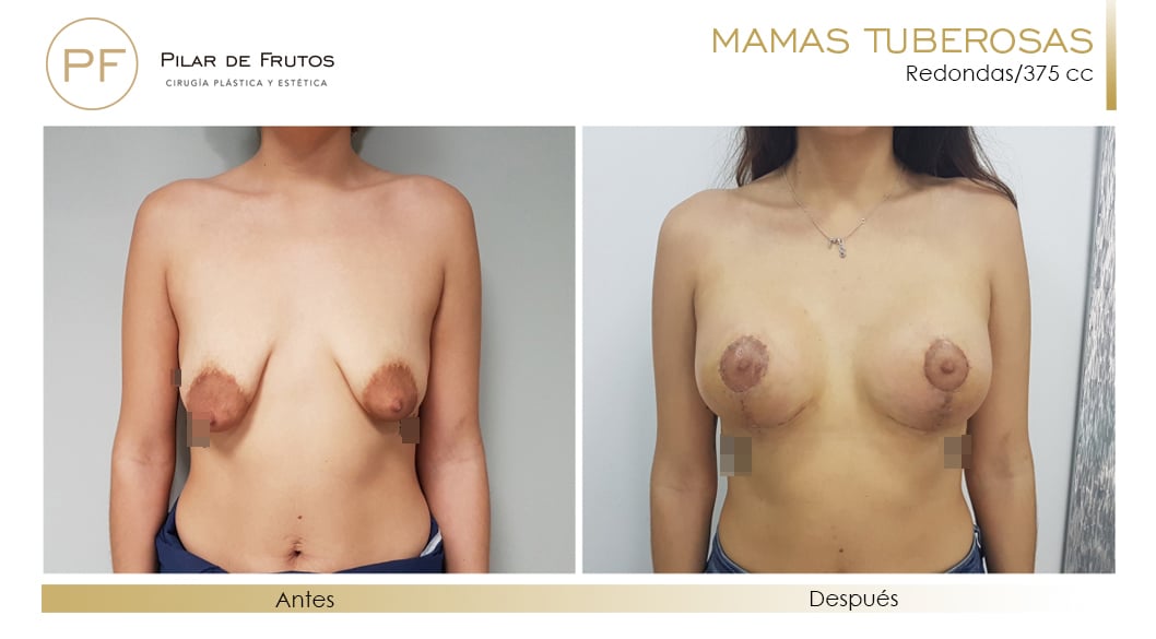 Mamas Tuberosas Antes y Después Mamas Tuberosas Antes y Después