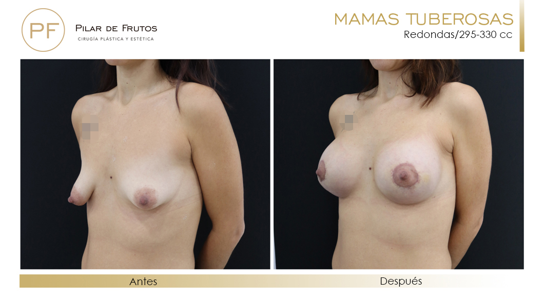 Mamas Tuberosas Antes y Después Mamas Tuberosas Antes y Después