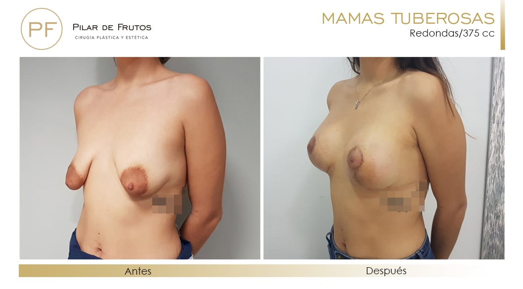 Mamas Tuberosas Antes y Después Mamas Tuberosas Antes y Después
