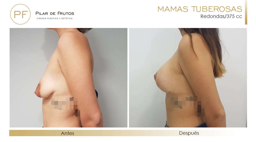Mamas Tuberosas Antes y Después Mamas Tuberosas Antes y Después