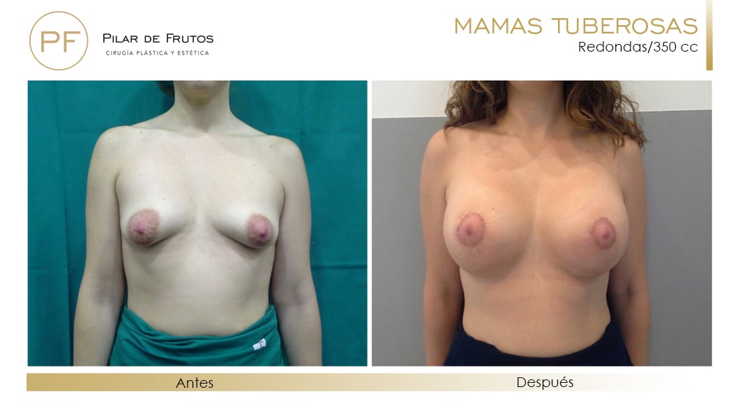 Mamas Tuberosas Antes y Después Mamas Tuberosas Antes y Después