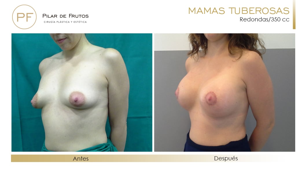 Mamas Tuberosas Antes y Después Mamas Tuberosas Antes y Después
