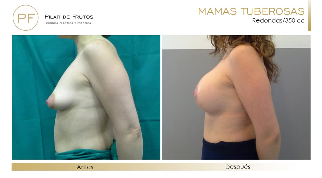 Mamas Tuberosas Antes y Después Mamas Tuberosas Antes y Después