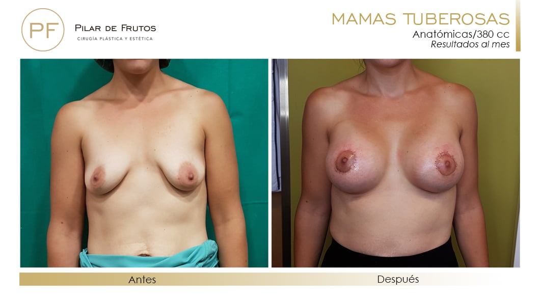 Mamas Tuberosas Antes y Después Mamas Tuberosas Antes y Después