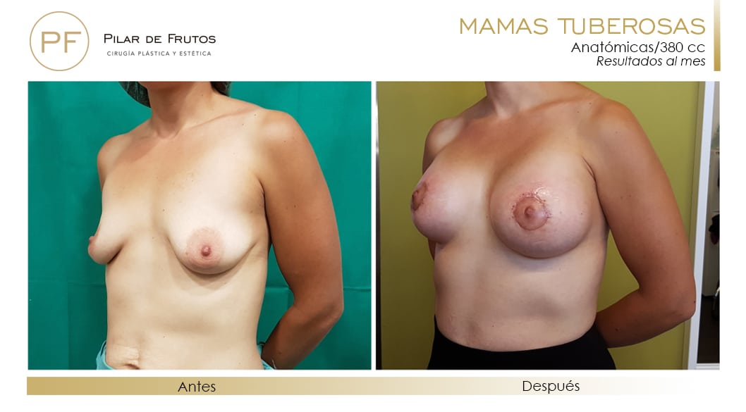 Mamas Tuberosas Antes y Después Mamas Tuberosas Antes y Después