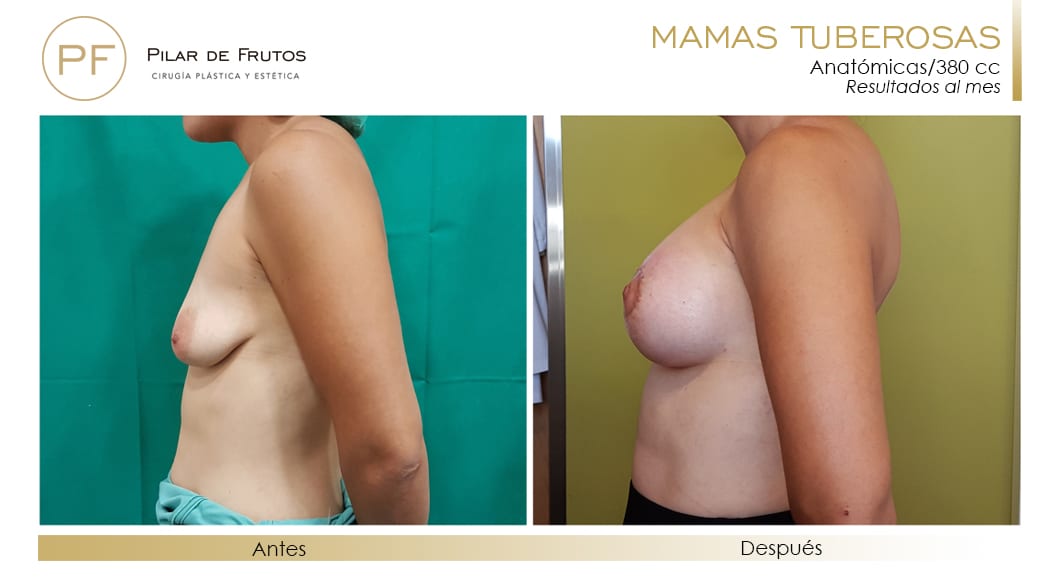 Mamas Tuberosas Antes y Después Mamas Tuberosas Antes y Después